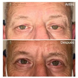 Cirugía de ptosis y blefaroplastia superior (caso real)
