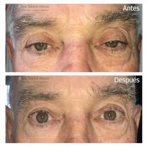 Cirugía de ptosis aponeurótica: antes y después