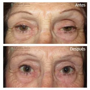 Ptosis palpebral
