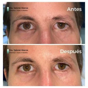 Parálisis facial