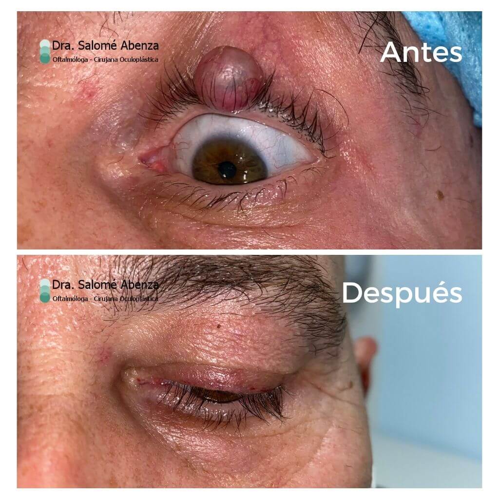 Tumor palpebral en ojo izquierdo antes y después de la cirugía