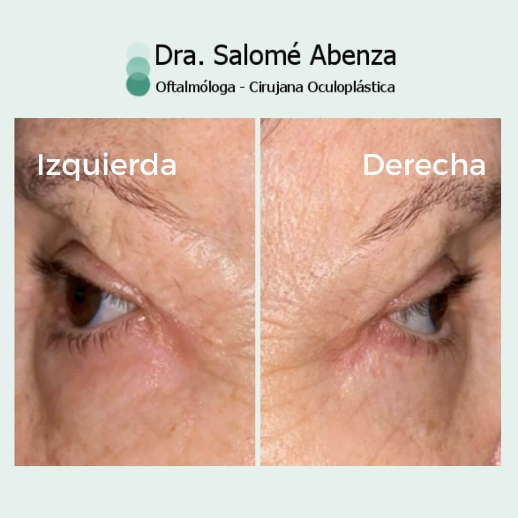 Blefaro completa con reposicion grasa.
