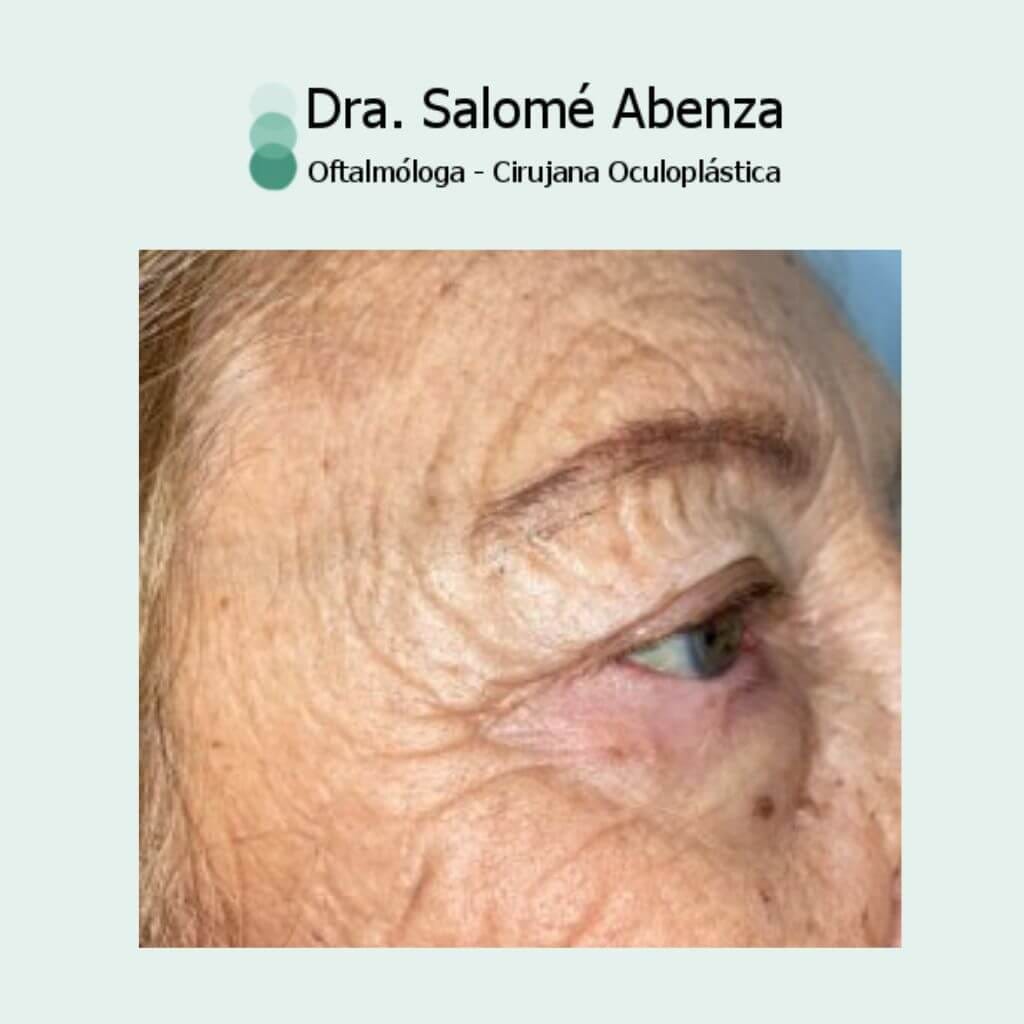 Extirpación de Carcinoma basocelular en canto externo derecho que generaba entropion cicatricial. Reconstrucción mediante injerto tarsoconjuntival del párpado superior y tira periostica junto con colgajo miocutáneo de Tripier.  Recuperación estética y funcional con estabilidad a los 6 meses de la intervención sin signos de recidiva tumoral.