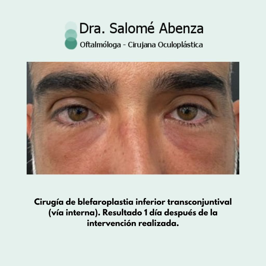Blefaroplastia inferior transconjuntival (vía interna). Un día después de la intervención.