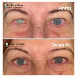 Prótesis ocular a medida: resultado a los 3 meses