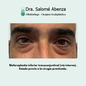 Blefaroplastia inferior transconjuntival (vía interna). Previo a la cirugía de blefaroplastia inferior.