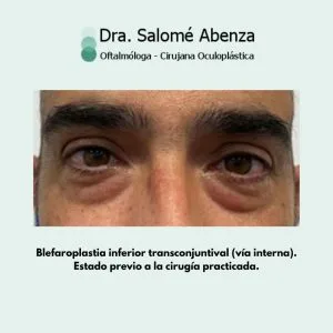 Blefaroplastia inferior por vía interna en hombre