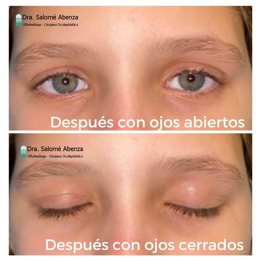 Ptosis palpebral congénita: Detalle de ojos abiertos y cerrados tras la círugía de resección de aponeurosis vía anterior derecha a los 6 meses de la intervención.