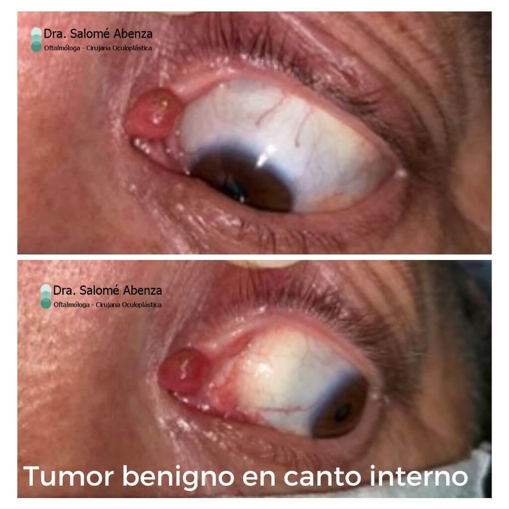 Tumor benigno en canto interno izquierdo (nevus) vista en detalle antes de practicar la cirugía.