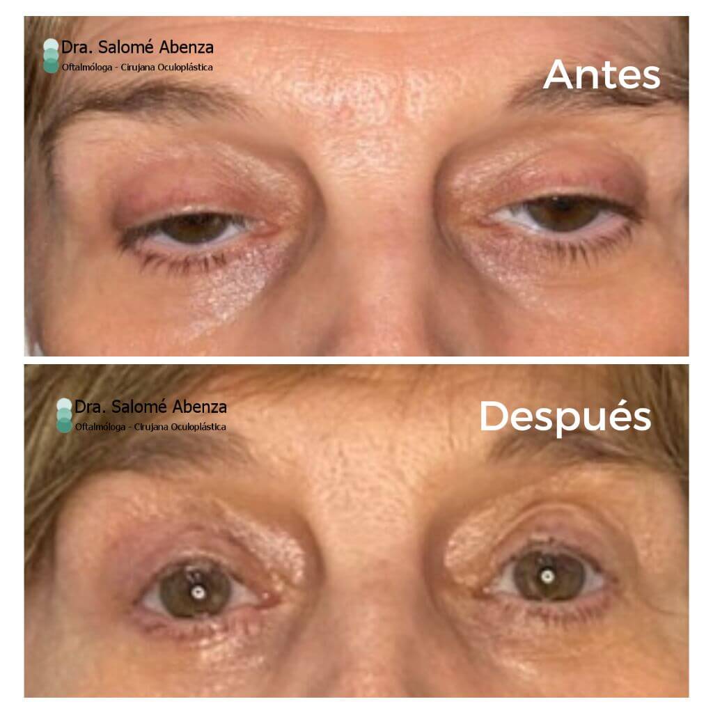 Paciente con Distrofia oculofaríngea (DOF) con ptosis palpebral severa