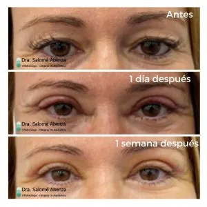 Blefaroplastia superior: evolución del resultado