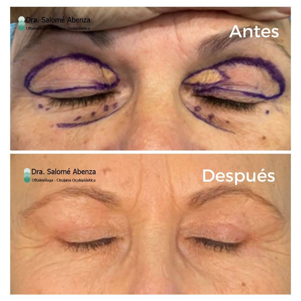 Antes y depsués, con los ojos cerrados, de Blefaroplastia superior con extirpación de xantelasmas (acúmulos amarillentos de grasa) y blefaroplastia inferior transconjuntival (por dentro del párpado sin cicatrices) asociado a cantopexia bilateral para tensado palpebral. 