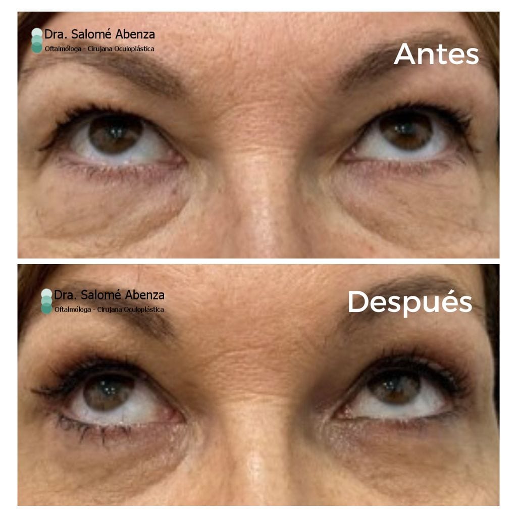 Cirugía de blefaroplastia superior e inferior transconjuntival con cantopexia bilateral a los 6 meses de la intervención.  Detalles con mirada hacia arriba.