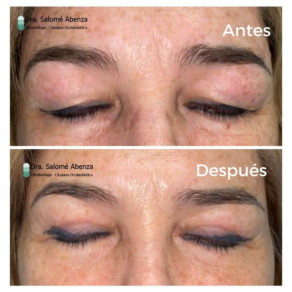 Blefaroplastia superior funcional para mejorar el campo visual, antes y después, a los 3 meses de la cirugía, detalle con los ojos cerrados. Intervención realizada en Murcia por la Dra. Salomé Abenza, oftalmóloga especializada en blefaroplastia y cirugía de párpados.