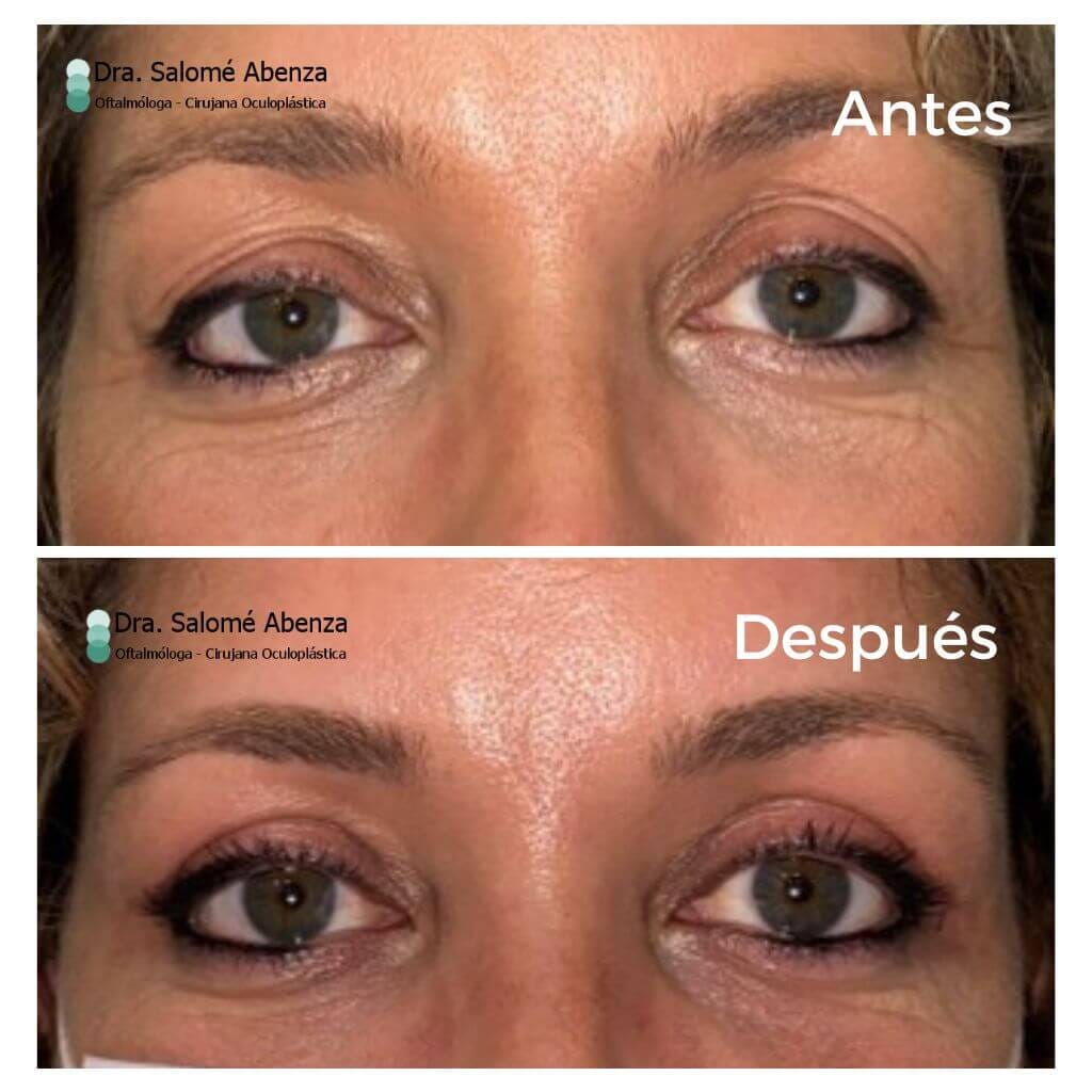 Cirugía de blefaroplastia superior, realizada por la Dra. Salomé Abenza, al mes de la intervención.