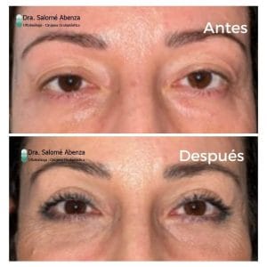 Cirugía de ptosis palpebral superior mediante reinsercion de aponeurosis vía anterior y blefaroplastia superior e inferior transconjuntival con cantopexia bilateral antes y después a los 2 meses de la intervención.