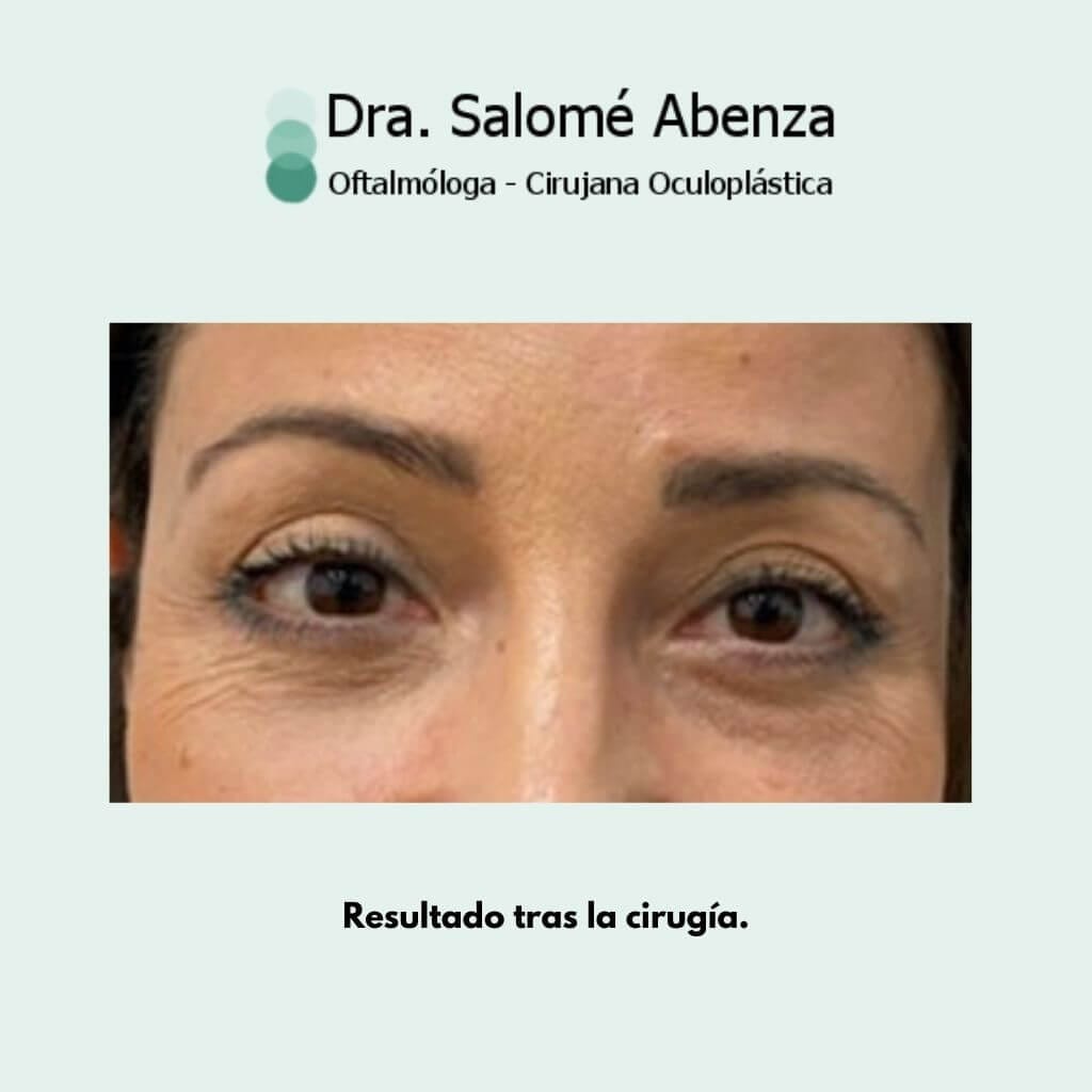 Cirugía de ptosis palpebral superior mediante reinsercion de aponeurosis vía anterior, blefaroplastia superior e inferior transconjuntival con cantopexia bilateral a los 2 meses de la intervención, resultado de las zonas tratadas.