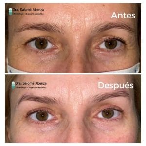 Cejaplastia temporal y blefaroplastia superior a los 6 meses de la intervención, realizada en Murcia por la Dra. Salomé Abenza.