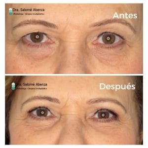 Blefaroplastia superior bilateral antes y tras 2 meses de la intervención. Cirugía realizada por la Doctora Salomé Abenza en Murcia.