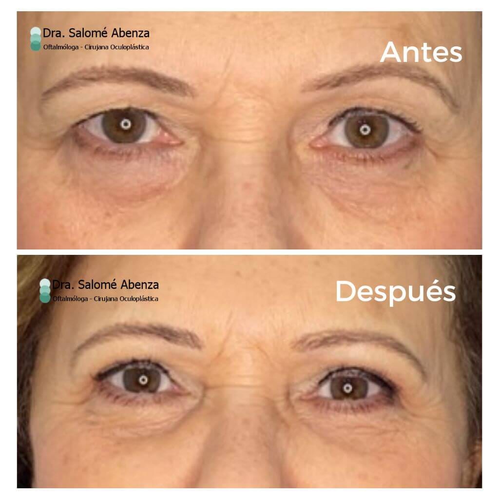 Blefaroplastia superior bilateral antes y tras 2 meses de la intervención. Cirugía realizada por la Doctora Salomé Abenza en Murcia.