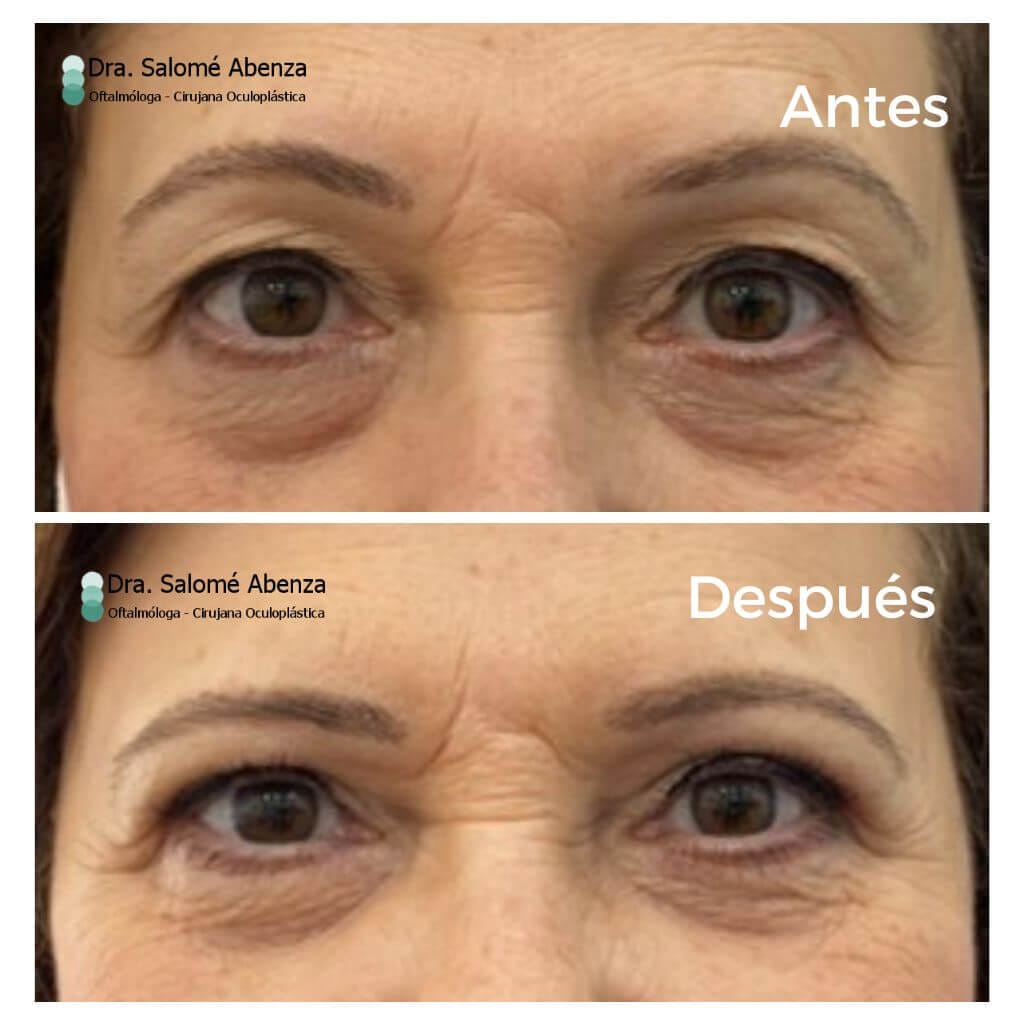 Blefaroplastia superior bilateral antes y tras 2 meses de la intervención. Detalle con los ojos abiertos. Cirugía realizada por la Doctora Salomé Abenza en Murcia.