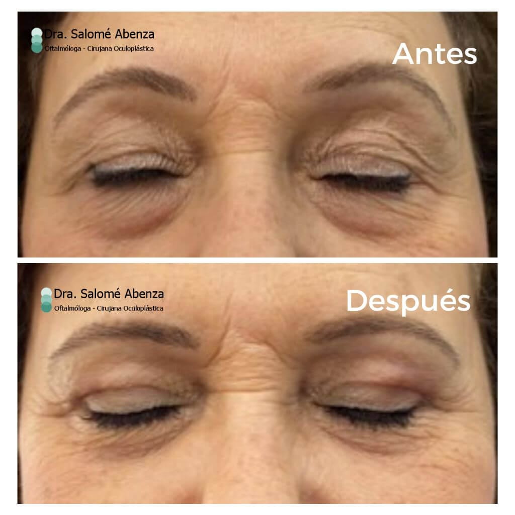 Blefaroplastia superior bilateral antes y tras 2 meses de la intervención. Detalle con los ojos cerrados. Cirugía realizada por la Doctora Salomé Abenza en Murcia.