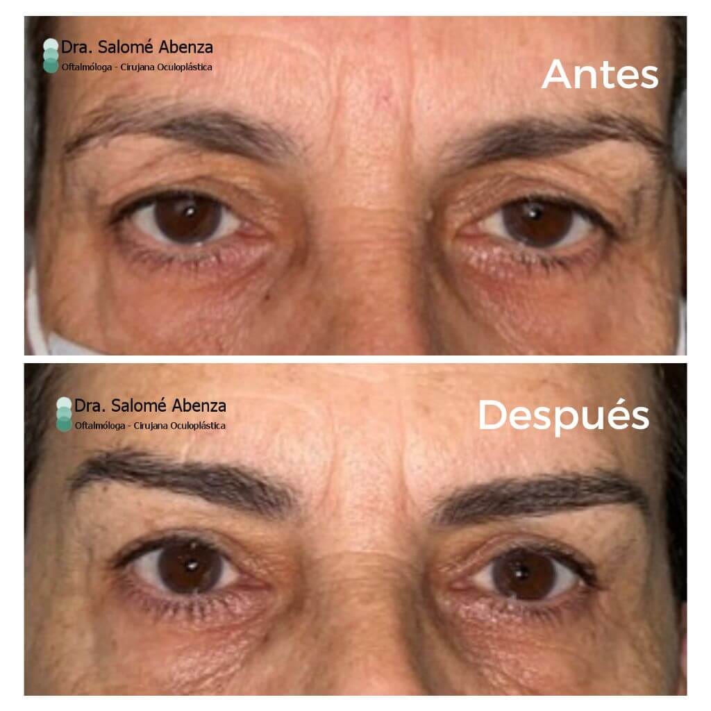 Cirugía de cejaplastia temporal y blefaroplastia superior a los 7 meses de la cirugía. Obsérvense las mínimas cicatrices de las cejas y el parpado superior.  