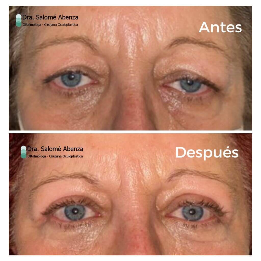 Ptosis palpebral aponeurótica: Cirugía de reinserción de aponeurosis vía anterior y blefaroplastia superior bilateral, con resultado a los 3 meses de la intervención.