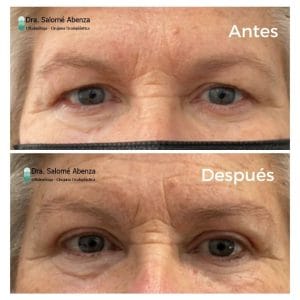 Cejaplastia directa y blefaroplastia superior antes y después, a los 2 meses de la cirugía.