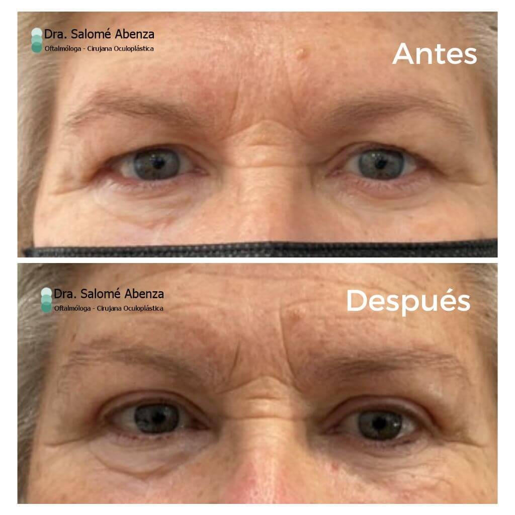 Cejaplastia directa y blefaroplastia superior antes y después, a los 2 meses de la cirugía. 