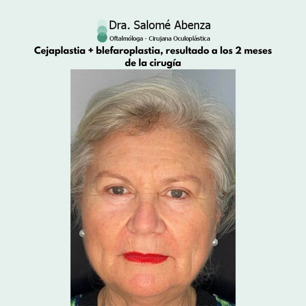 Cejaplastia directa y blefaroplastia superior con resultado a los 2 meses de la cirugía. 