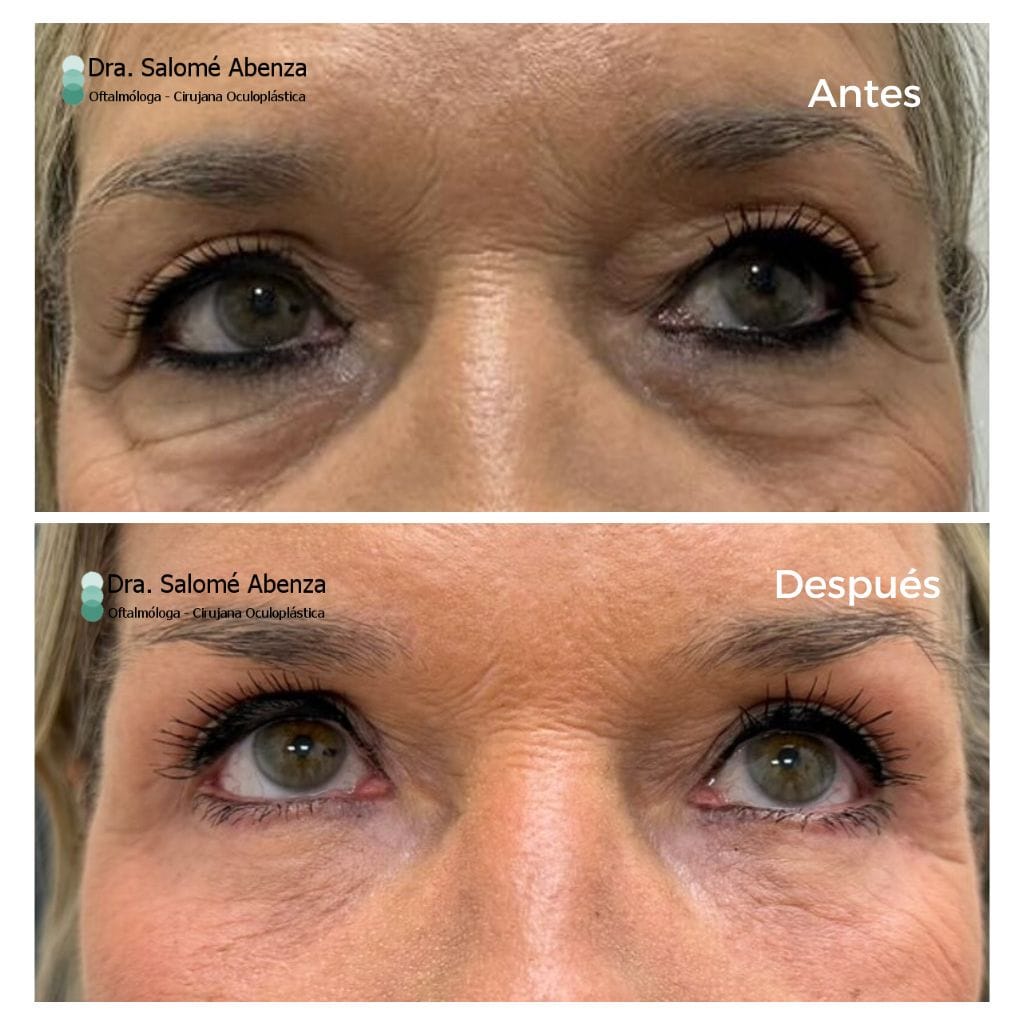 cirugía completa de parpados y cejas