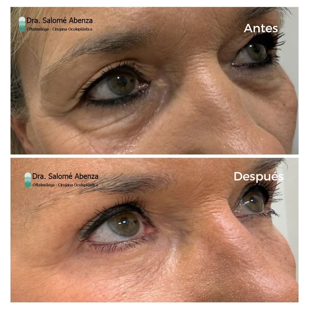 antes y después de cirugía de párpados completa y cejas, realizada por la Dra. Salomé Abenza en Murcia, vista de perfil.