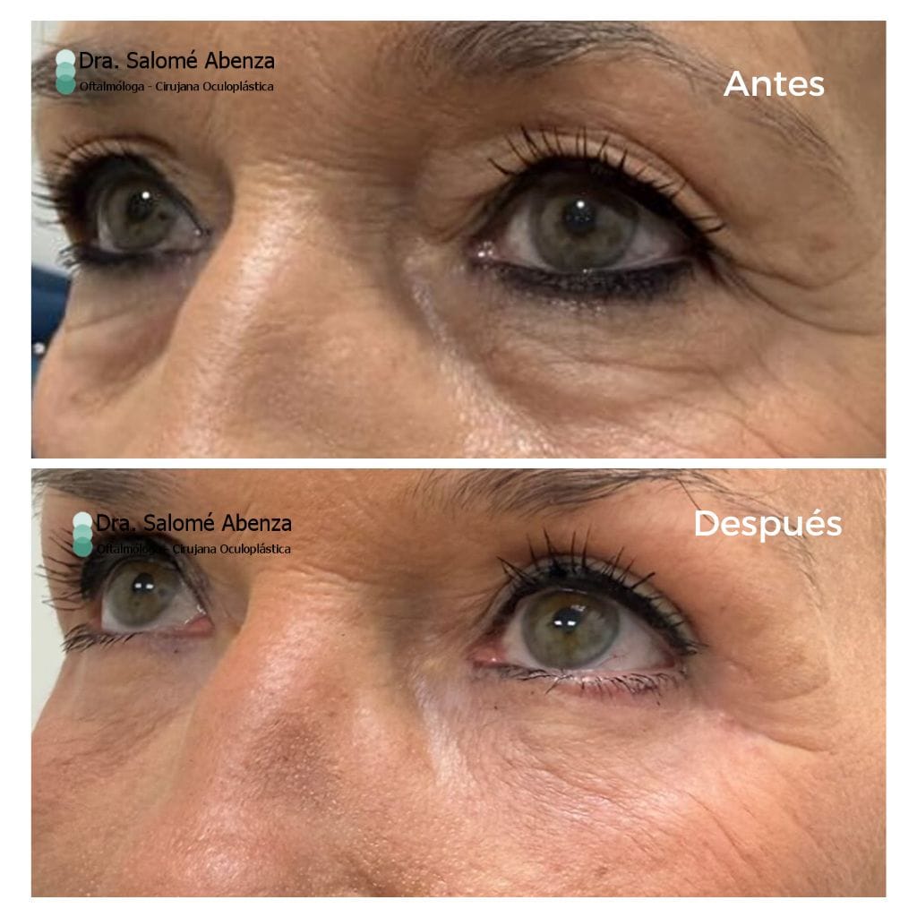 antes y después de cirugía completa de párpados y cejas, realizada por la Dra. Salomé Abenza en Murcia, vista de perfil izquierdo.