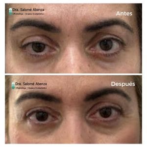 Ptosis párpado superior derecho y blefaroplastia superior bilateral
