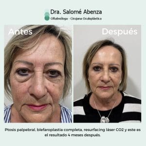 ptosis palpebral y blefaroplastia completa