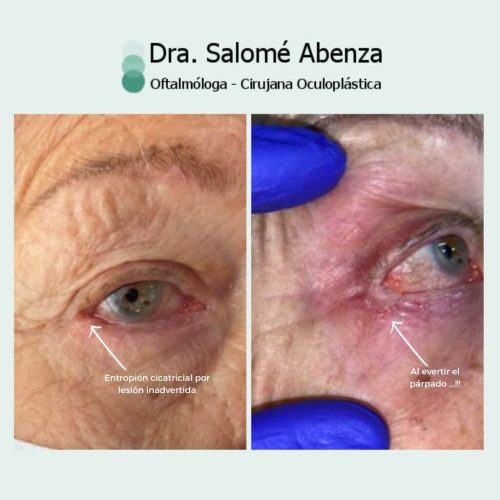 Dorctora Salomé Abenza Extirpación de Carcinoma basocelular en canto externo derecho que generaba entropion cicatricial. Reconstrucción mediante injerto tarsoconjuntival del párpado superior y tira periostica junto con colgajo miocutáneo de Tripier. Recuperación estética y funcional con estabilidad a los 6 meses de la intervención sin signos de recidiva tumoral.