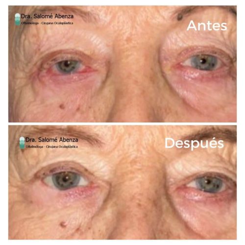 Extirpación de Carcinoma basocelular en canto externo derecho que generaba entropion cicatricial. Reconstrucción mediante injerto tarsoconjuntival del párpado superior y tira periostica junto con colgajo miocutáneo de Tripier. Recuperación estética y funcional con estabilidad a los 6 meses de la intervención sin signos de recidiva tumoral. Extirpación de Carcinoma basocelular en canto externo derecho que generaba entropion cicatricial. Reconstrucción mediante injerto tarsoconjuntival del párpado superior y tira periostica junto con colgajo miocutáneo de Tripier. Recuperación estética y funcional con estabilidad a los 6 meses de la intervención sin signos de recidiva tumoral.