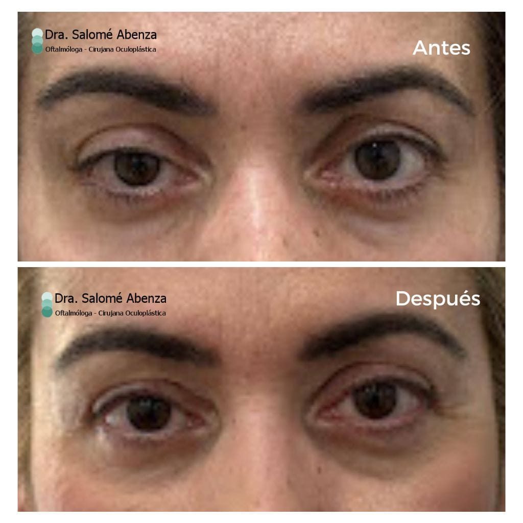 Ptosis párpado superior derecho y blefaroplastia superior bilateral
