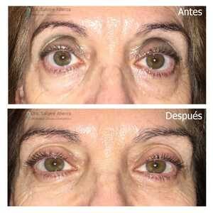 Antes de la blefaroplastia inferior y resultado después de la intervención