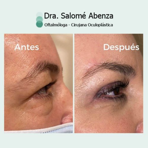 Blefaroplastia superior e inferior antes y a los 3 meses de la cirugía con cantopexia en párpados inferiores y cejaplastia lateral. Vista de perfil derecho. Blefaroplastia superior e inferior antes y a los 3 meses de la cirugía con cantopexia en párpados inferiores y cejaplastia lateral. Vista de perfil derecho.