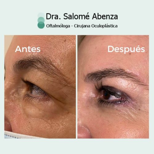 Blefaroplastia superior e inferior antes y después a los 3 meses de la cirugía con cantopexia en párpados inferiores y cejaplastia lateral. Vista de perfil izquierdo. Blefaroplastia superior e inferior antes y después a los 3 meses de la cirugía con cantopexia en párpados inferiores y cejaplastia lateral. Vista de perfil izquierdo.