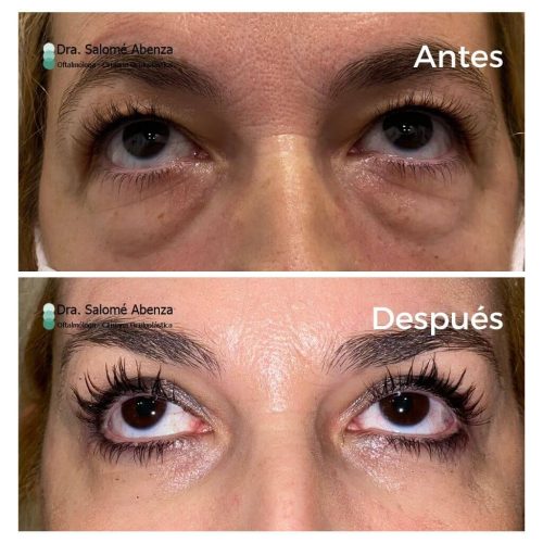 Blefaroplastia superior e inferior antes y a los 3 meses de la cirugía con cantopexia en párpados inferiores y cejaplastia lateral. Vista de frente con mirada arriba. Blefaroplastia superior e inferior antes y a los 3 meses de la cirugía con cantopexia en párpados inferiores y cejaplastia lateral. Vista de frente con mirada arriba.