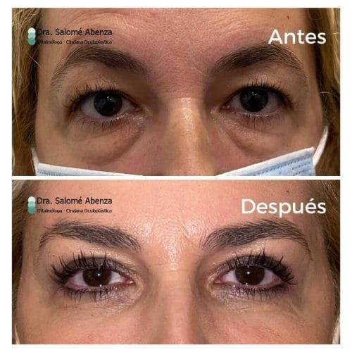 Blefaroplastia superior e inferior antes y a los 3 meses de la cirugía con cantopexia en párpados inferiores y cejaplastia lateral. Vista con mirada al frente. Blefaroplastia superior e inferior antes y a los 3 meses de la cirugía con cantopexia en párpados inferiores y cejaplastia lateral. Vista con mirada al frente.