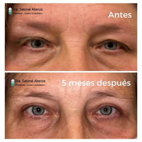 Evolución de cirugía de blefaroplastia superior. Postoperatorio inmediato al termina la cirugía y resultado final a los 5 meses.
