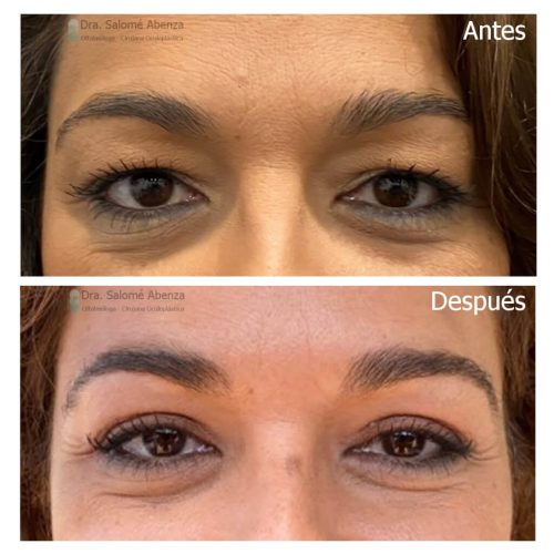 Blefaroplastia superior bilateral antes y después Blefaroplastia superior bilateral antes y después