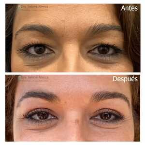 Antes de la intervención de blefaroplastia superior y resultado después de la operación.