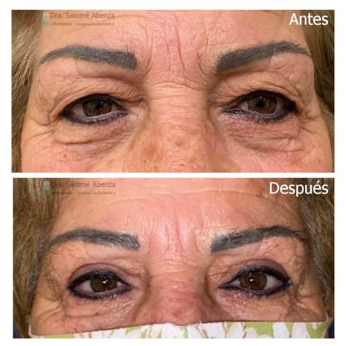 Blefaroplastia superior bilateral antes y después Blefaroplastia superior bilateral antes y después