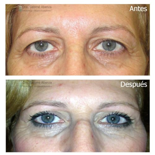 Blefaroplastia superior bilateral antes y después Blefaroplastia superior bilateral antes y después