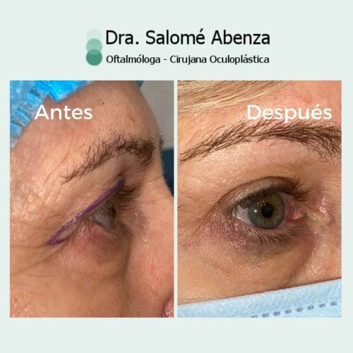 Dorctora Salomé Abenza Blefaroplastia superior bilateral antes de la cirugía, se puede observar el exceso de piel encima de las pestañas.